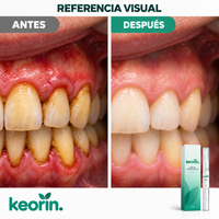 Antes y después con KEORIN