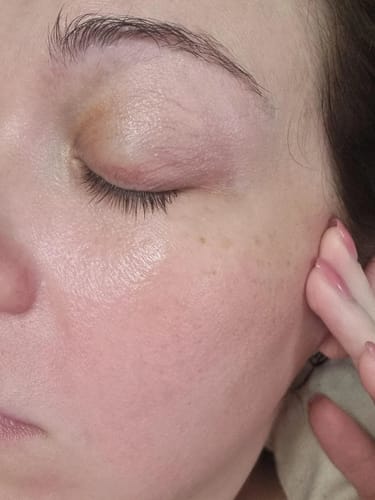 Resultado KEORIN Retinal Shot